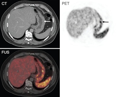 Resection of a duodenal gastrinoma in 2006 and clinical suspicion of recurrence in August 2008 in a 54-year-old man. On the Ga-68 DOTATATE PET/CT scan, intense uptake suspicious for recurrent NET within the gastric wall was observed. In September 2008, a gastrinoma with an 8-mm diameter was resected. CT shows no suspicious findings (arrow), while PET shows an intense focal uptake (arrow). Fused (FUS) PET/CT image indicates intense uptake located within the gastric wall. Images courtesy of Radiology.