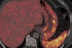 2014 02 20 17 31 07 273 Pet Ct Net Haug Rad 450 20140221003342