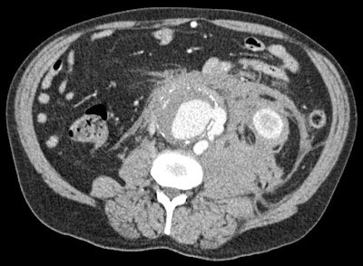 A middle-aged patient with abdominal pain considered on clinical grounds to be due to diverticulitis. Contrast-enhanced CT reveals active retroperitoneal haemorrhage from an actively leaking abdominal aortic aneurysm. Radiology (CT in this case) completely alters the diagnostic thinking and the therapeutic strategy, thereby having an impact on the outcome of the patient, who survived aortic surgery. Image courtesy of Dr. Adrian Dixon.