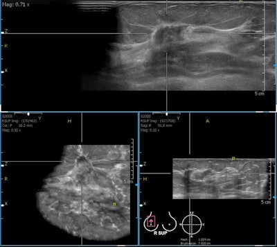 A 76-year-old woman with invasive ductal cancer of the right breast. Automated breast ultrasound shows extremely hypodense, irregular, spiculated mass lesion with dorsal shadowing (BI-RADS 5). Notice coronal view on the bottom left with retraction feature of invasive cancer not seen in transversal or sagittal views. Image courtesy of Dr. Maria Bernathova, Medical University of Vienna.
