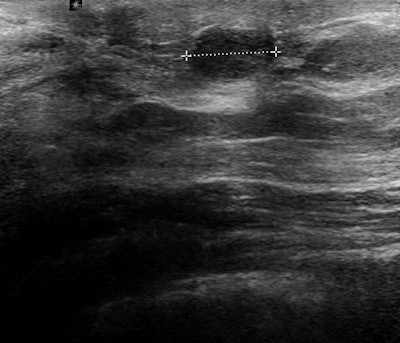 Ultrasound of the subareolar region shows a superficial 8-mm, round, solid, homogeneous tumor that turned out to be a papilloma. This is the most frequently found benign tumour in this part of the breast. Image courtesy of Dr. Rafael Salvador.