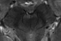 2014 03 05 17 39 44 591 7 T Parkinsons Cosottini Rad 20140306004027