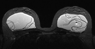 Identification of several visual patterns of collapsed and folded elastomer shell floating in gel: 'linguine,' 'keyhole,' 'teardrop,' 'inverted teardrop,' and 'noose' signs depict silicone visible both inside and outside a radial fold. Image courtesy of Marike Maijers.