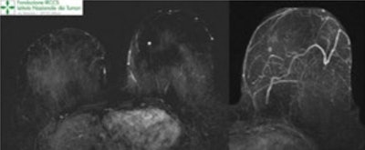 Same patient as above. A second-look ultrasound was performed demonstrating an ill-defined, irregular lesion corresponding to the enhancing lesion on MRI. It was biopsied. At histology, it was an invasive ductal carcinoma, and the patient underwent conservative surgery. Chemotherapy was discussed and agreed upon in the multidisciplinary meeting.