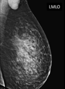 Mammogram shows rounded mass