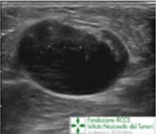 A 65-year-old patient presented with a recent history of a new lump in the left axilla. Clinical examination confirmed a discrete hard palpable mass in the left axilla, in keeping with suspicious finding without clinical breast abnormalities. Mammography and ultrasound were required. Corresponding to the palpable lump, on left mammogram (top) is a rounded mass without any breast lesions, and on ultrasound (bottom) a hypoechoic lesion with no hilum, in keeping with malignant metastatic lymph node. All images courtesy of Dr. Pietro Panizza.