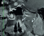 High-resolution (3-tesla) MRI of a patient with an inflammatory endoperiodontal lesion at tooth 017 (arrow). Sagittal T2-weighted space (A), T1-weighted plus gadolinium (B). Images courtesy of Dr. Stefan Rohde.