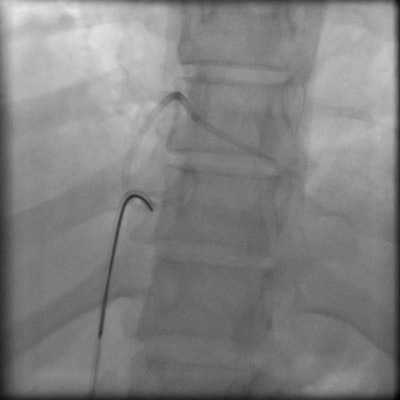 Interventional retrieval of portacath fragment