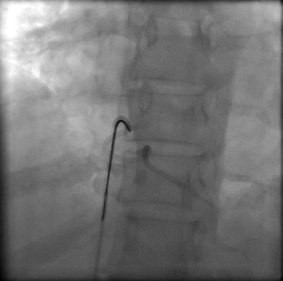 Interventional retrieval of portacath fragment
