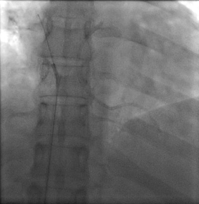 Interventional retrieval of portacath fragment