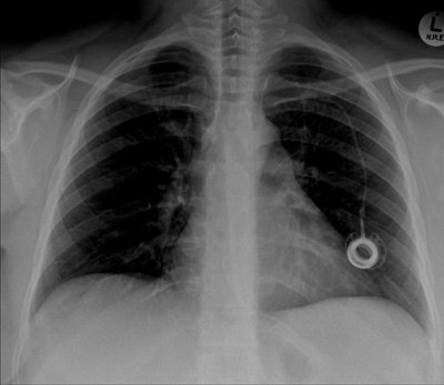 Chest radiograph of a 32-year-old woman shows cardiac migration of the proximal fragment of a fractured portacath. All images courtesy of Drs. Jamal Al Deen Alkoteesh and Maysam T. Abu Sa'a.