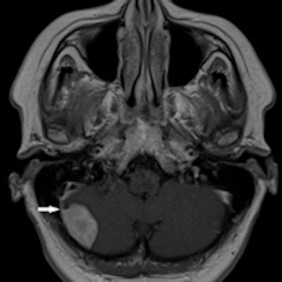 2014 03 10 09 26 29 176 Andrzej Brainglioma 200