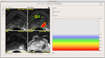 2014 03 18 10 28 34 465 2014 03 18 Cad Mri Prostate 525