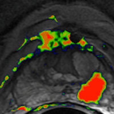 2014 03 18 10 28 35 967 2014 03 18 Cad Mri Prostate 200