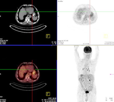A 68-year-old man with an 8-mm distal esophageal mass with biopsy-proven squamous cell carcinoma. On coronal PET, axial PET, and axial fused PET/CT images (above), the primary tumor demonstrates no significant FDG uptake. Axial CT image shows esophageal mass at the same level. In the same patient, functional perfusion maps of blood volume, blood flow, and permeability surface (below) reveal the intratumoral perfusion distribution. CT perfusion values for blood volume (left), blood flow (right), and permeability surface (bottom) were 9.62 mL/100 mL, 86.67 mL/100 mL/min, and 12.65 mL/100 mL/min, respectively. All images courtesy of Dr. Mecit Kantarci.