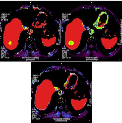 CT perfusion of esophageal cancer