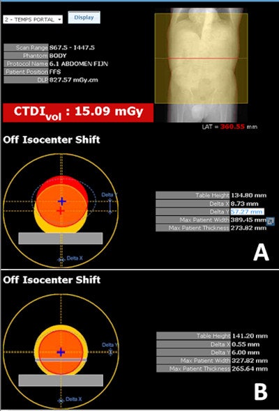 The DoseWatch software showed that the patient was positioned too high in the gantry, resulting in a higher CTDIvol (A). Correct position in the gantry (B).