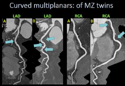 Differences can be seen in the vessel shapes and the plaque burden of monozygotic twins. In multiplanar images above, both twins have plaque, but twin B has three high-risk plaques in the left anterior descending artery that are not present in twin A. Twin B has another high-risk plaque in the right coronary artery.