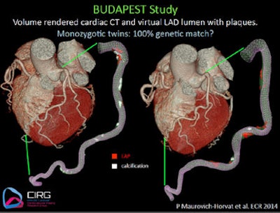 The hearts of identical twins are morphologically similar but show differences in morphology and geometry. All images courtesy of Dr. Pál Maurovich-Horvat.