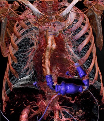 A 60-year-old man was examined with dual-energy CT (Somatom Definition Flash, Siemens Healthcare) in 2012 at the Center for Medical Image Science and Visualization (CMIV) at Linköping University. Dual energy was used to reduce metal artifacts from the pump. A new way to enhance the image quality and reduce noise was then added, and raw data from the CT were processed with iterative reconstruction software. The resulting image dataset was finally produced using volume-rendering 3D. This high-resolution image, similar to the version Wellcome awarded, won an award from the Royal Photographic Society and was selected for the International Images for Science Exhibition 2013. Image courtesy of Dr. Anders Persson.