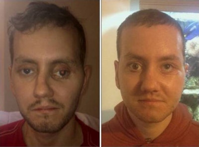 Stephen Power pictured before and after 3D facial surgery. All images courtesy of Adrian Sugar.