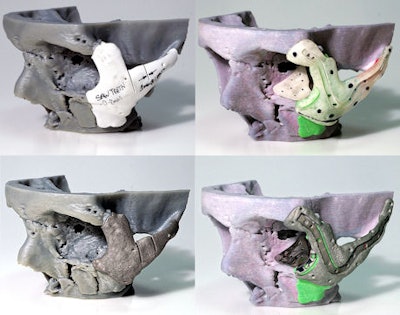 A 3D mold of the patient's face was made before the titanium implants were created.