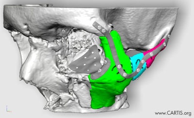 Power's skull and cheekbones were repositioned using plate designs. The project is the work of the Centre of Applied Reconstructive Technologies in Surgery (Cartis).