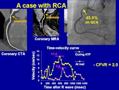 RCA stenosis