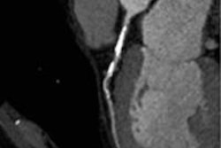 2014 04 30 09 29 03 606 Vliegenthart stenosis 20140430163807