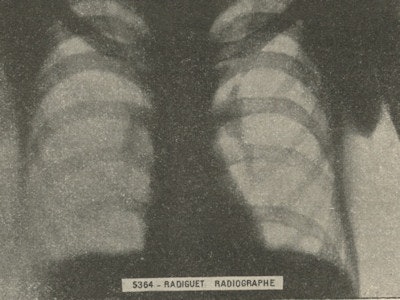 Fig. 2: Chest radiograph (1901).