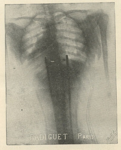 Fig. 5: Radiograph of a young woman wearing a corset.