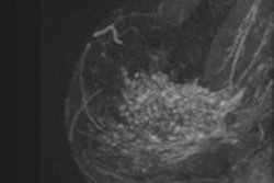 2014 05 16 08 08 36 306 2013 11 04 Breast Mri Thumb2