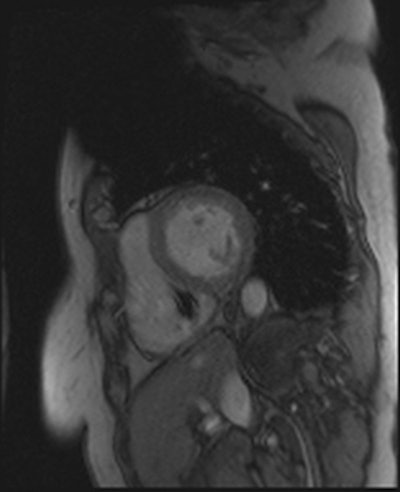 2014 05 23 13 15 09 104 2014 05 21 Pacemaker Flash Cine Edited