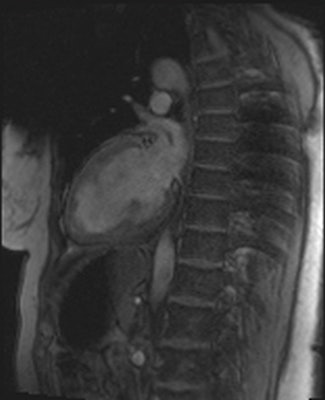 Artifacts are shown in cardiovascular MR patient imaged using spoiled gradient echo cine sequences in short-axis and two-chamber planes. Images courtesy of Touko Kaasalainen.