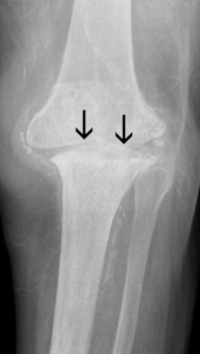 knee MRI