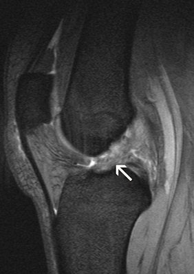 Anterior cruciate ligament tear. MRI reveals a swollen cruciate ligament; the knee joint can no longer be stabilized.