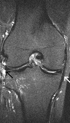 These images show the three most common knee injuries. Left: Osteoarthritis. On the x-ray, the osteoarthritis is clearly recognizable, with the narrowed joint space. Right: Lateral ligament tear. MRI shows the torn lateral ligament (black arrow). The medial ligament (white arrow) is still intact. Copyright of all images: Universitätsklinikum Essen.