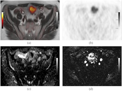 Simultaneous F-18 FDG-PET/MRI-acquired image of a patient with a sigmoid tumor. Fused axial T2 and PET (a), PET alone (b), MRI apparent diffusion coefficient map (c) and representative subtracted image from a dynamic contrast-enhanced MRI series (d) show increased metabolism, cellularity, and vascularity. Produced from an imaging unit at the Institute of Nuclear Medicine, University College London. Figures republished with permission of British Institute of Radiology, from [Chowdhury R, Ganeshan B, Irshad S, Lawler K, Eisenbl¨atter M, Milewicz H, et al. The use of molecular imaging combined with genomic techniques to understand the heterogeneity in cancer metastasis. Br J Radiol, 2014;87:20140065.]