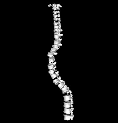 Reconstructed image from the CT scan of spinal vertebrae.