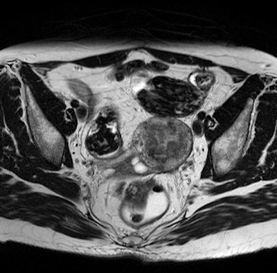 Axial T2-weighted image of a thickened right uterosacral ligament in a 42-year-old patient.