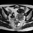 2014 05 30 10 04 50 477 2014 05 30 Drk Endometriomas Uterosacral Ligaments 20140530171447