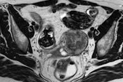 2014 05 30 10 04 50 477 2014 05 30 Drk Endometriomas Uterosacral Ligaments 20140530171447