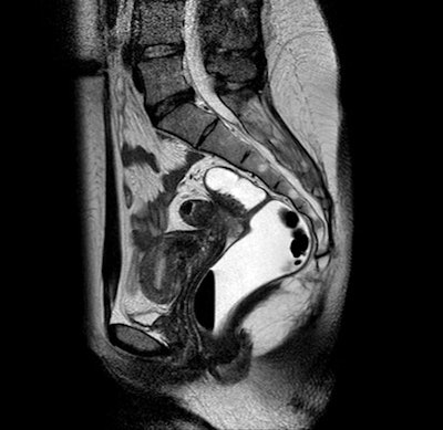 A 25-year-old woman with endometrial lesions of the rectosigmoid colon. Sagittal T2-weighted image showing a hyperintense nodule infiltrating the sigmoid wall.