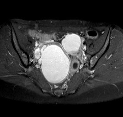 Axial T1-weighted image of a 29-year-old woman with bilateral endometriomas. All images courtesy of Dr. Julia Wenzel.