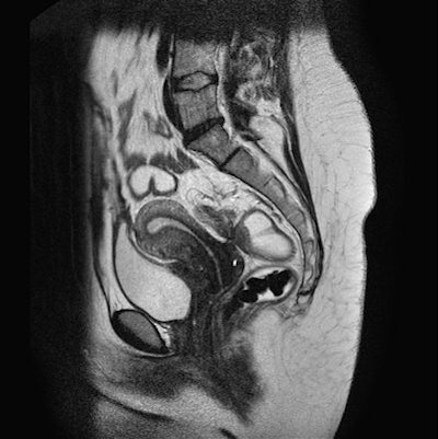 A sagittal T2-weighted image of a 32-year-old woman with endometrial lesions of the Douglas pouch as well as the posterior bladder wall.