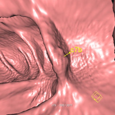 Flat polyp (11 mm) in the ascending colon shown with a CAD marker. CAD helped 5/7 readers to detect this lesion. Also, 2/7 readers detected the lesion already in the unassisted read. Image courtesy of Dr. Thomas Mang.