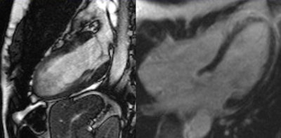 Takotsubo cardiomyopathy, also known as transient apical ballooning syndrome or stress cardiomyopathy. General MRI features include regional ventricular ballooning (apical, as in this case, and sometimes midventricular or basal), reduction of left ventricular ejection fraction, myocardial edema corresponding to regional wall motion abnormality (not shown), and absence of significant fibrosis/necrosis on late enhancement imaging (not shown).