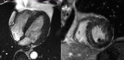 Hypertensive heart disease. General MRI features include concentric hypertrophy of the left ventricular (LV) myocardium, end-diastolic thickness of interventricular septum >13 mm, impaired systolic LV function, scattered zones of late enhancement, and sometimes (as in this case) diffuse edema pattern.