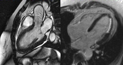 Acute myocardial infarction. General MRI features include regional wall motion abnormality, myocardial edema corresponding to regional wall motion abnormality, subendocardial to transmural late-enhancement (depending on infarct severity), and embolic infarction in side wall of left ventricle. All images courtesy of Dr. Tilman Emrich.
