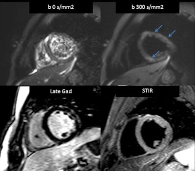 Acute myocarditis seen at (clockwise from upper left), low b value MRI, high b value MRI, short-tau inversion recovery (STIR), and late gadolinium enhancement (LE). All images courtesy of Dr. Jordi Broncano.